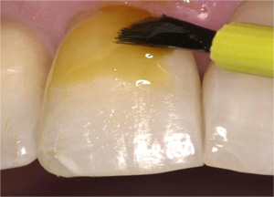 fluoride_varnish2.jpg